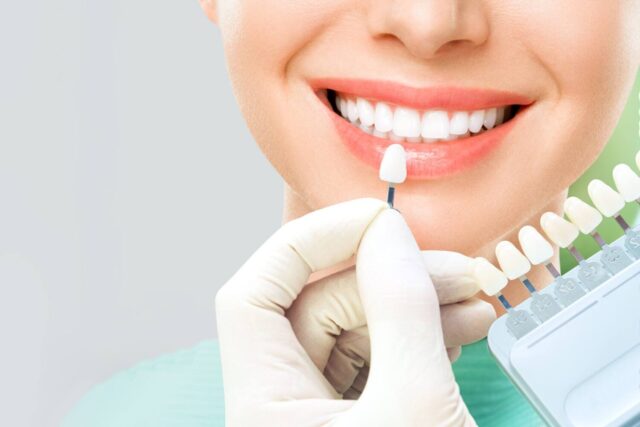 01-Dentist-choosing-the-color-of-veneers-for-your-patient-using-the-porcelain-veneer-color-chart_Porcelain-veneers-vs.-bonding